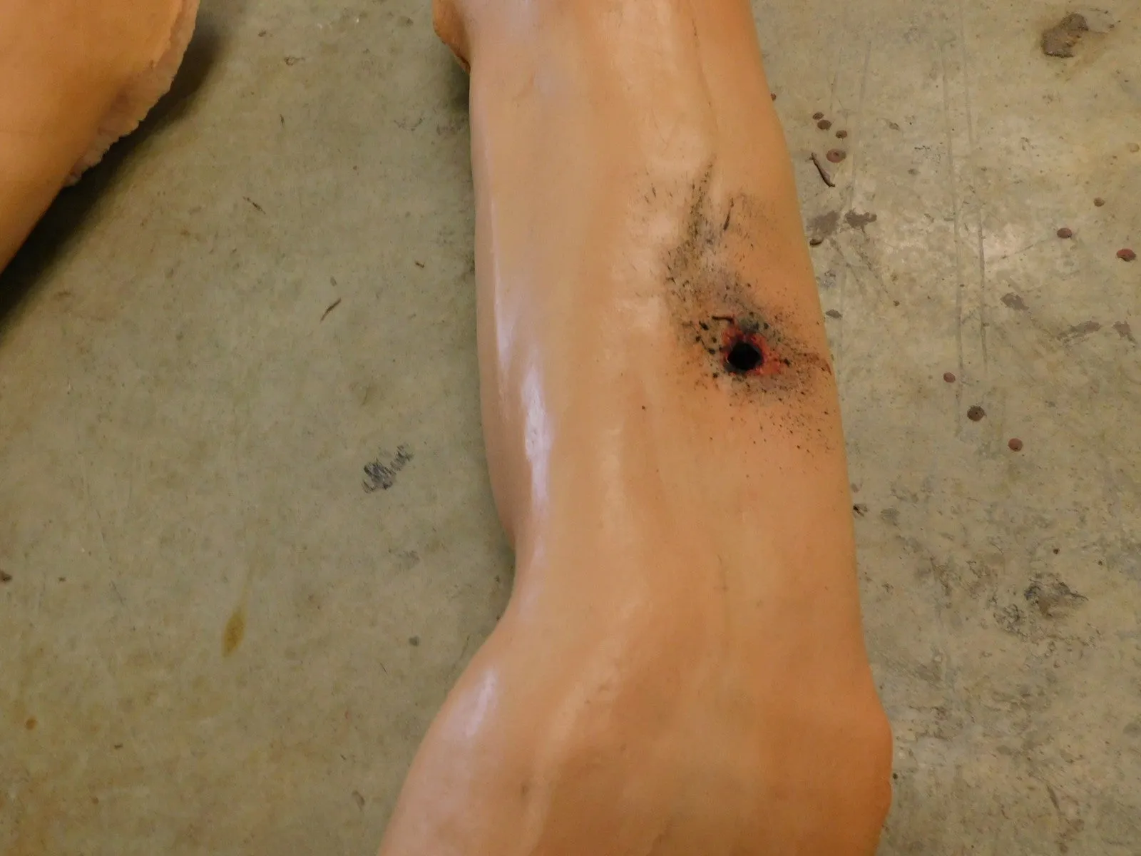 Dura Martin Arm with Gunshot Through and Through